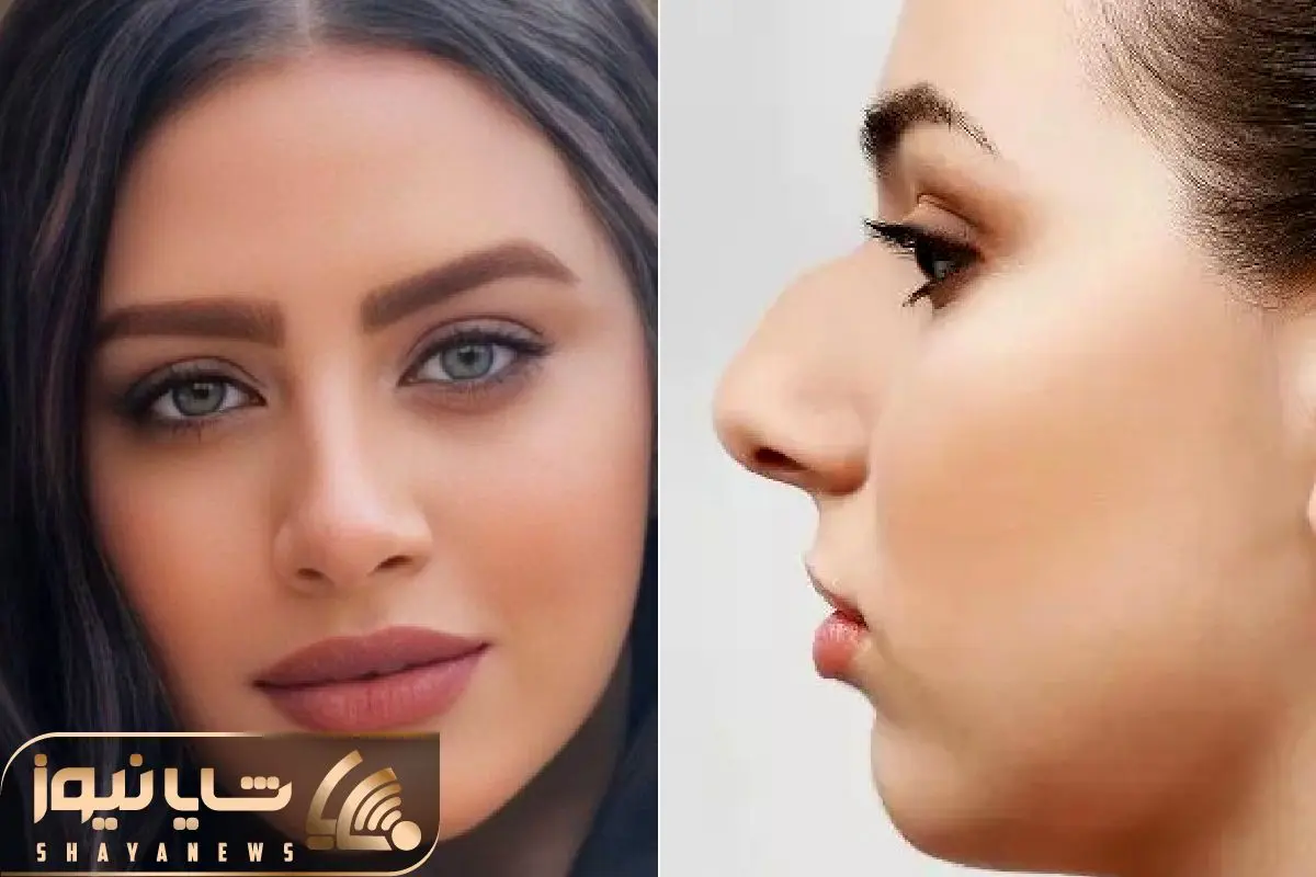 مدل های زیبای بینی گوشتی بعد از عمل؛ با اینا میتونی ببینی دماغتو عمل کنی چه شکلی میشی
